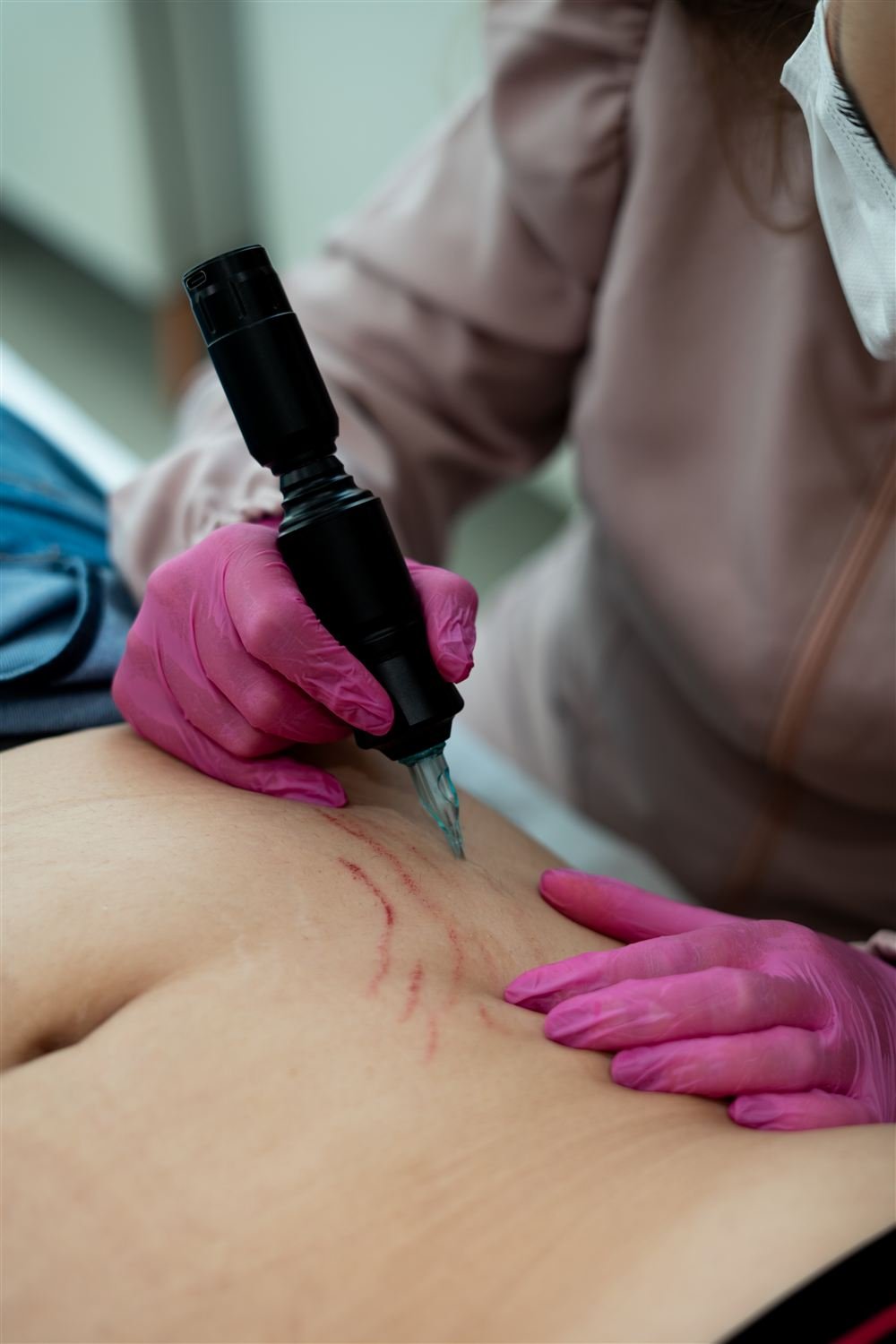 Protocolo de tratamento de estrias sendo aplicado